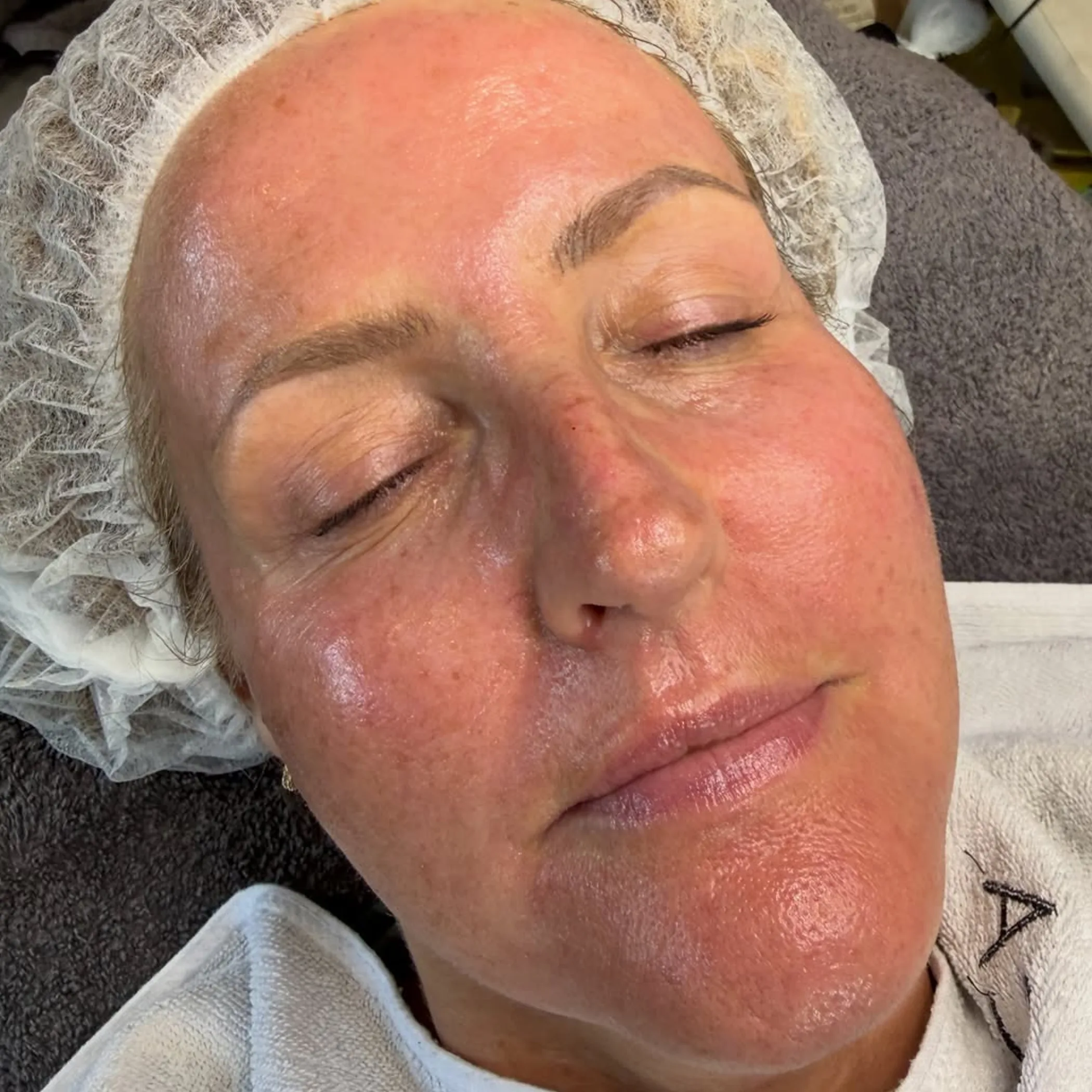 close-up of skin after microneedling